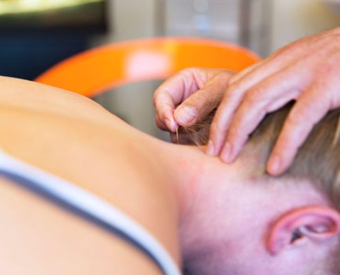 Dry Needling